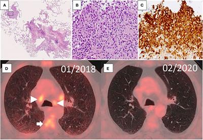 Case Report: Opposite Effects of BRAF Inhibition on Closely Related Clonal Myeloid Disorders